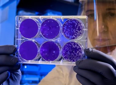 Cientistas Anunciam Primeira Mulher Possivelmente Curada da HIV