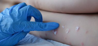 Lacen tem 29 diagnósticos positivos de varíola dos macacos após início de testes